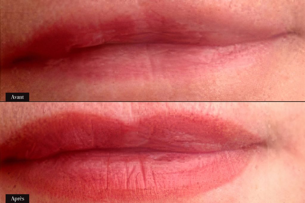 Avant/Après maquillage permanent lèvres