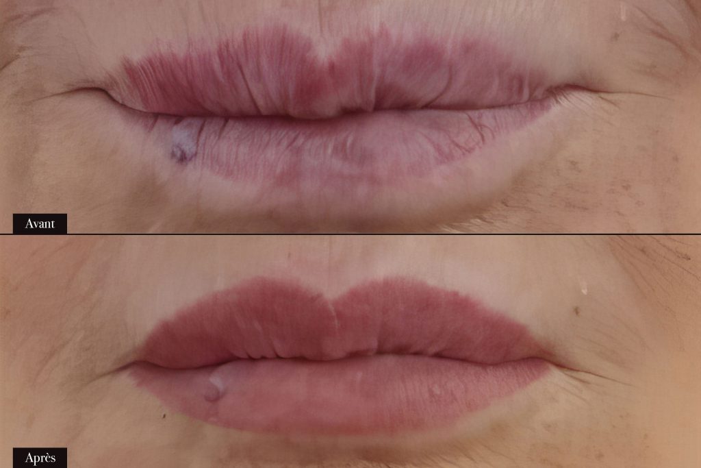 Avant/Après maquillage permanent lèvres