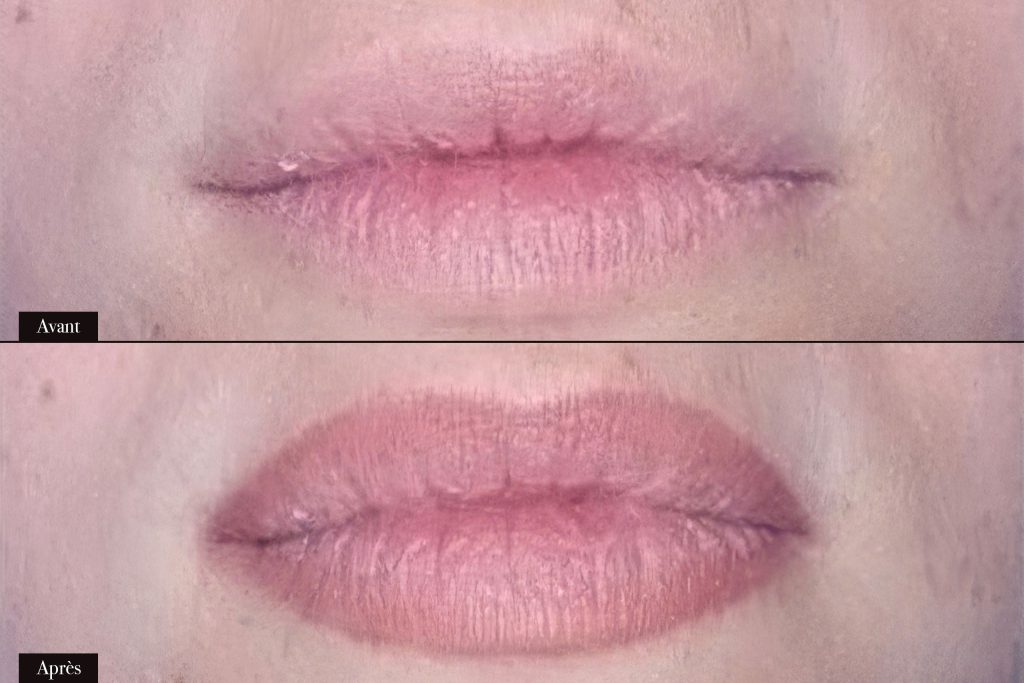 Avant/Après maquillage permanent lèvres
