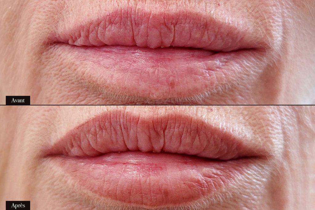 Avant/Après maquillage permanent lèvres