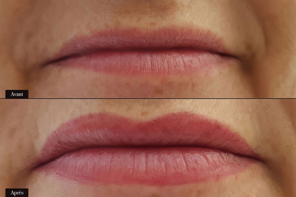 Avant/Après maquillage permanent lèvres